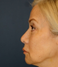 Feel Beautiful - Revision Rhinoplasty 203 - After Photo